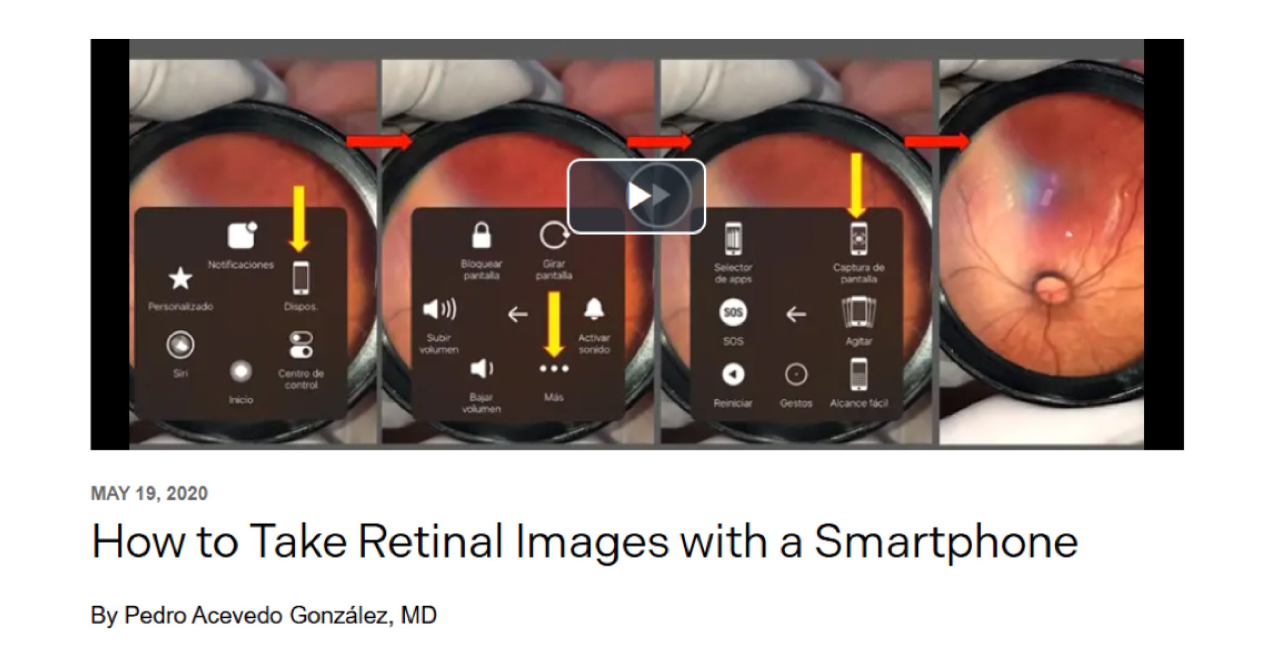 How to Take Retinal Images with a Smartphone